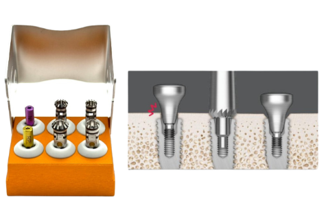 Dental Master Implant Bone Profiler (Outer Box)